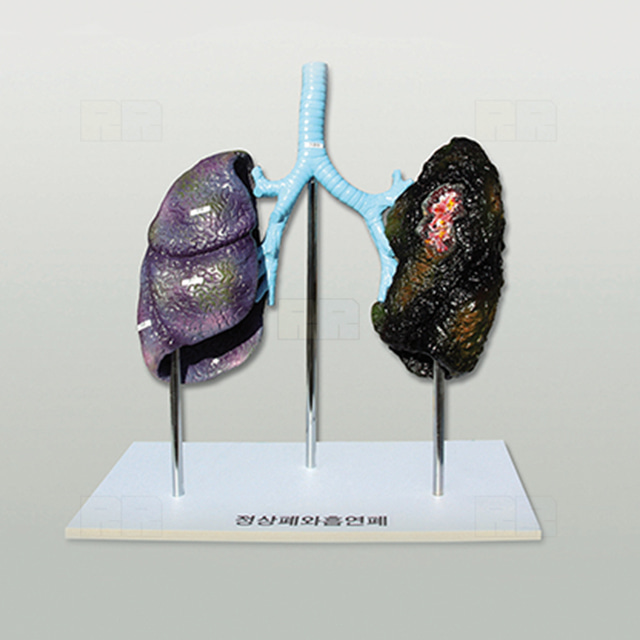 폐의 비교 (정상폐와 흡연폐)